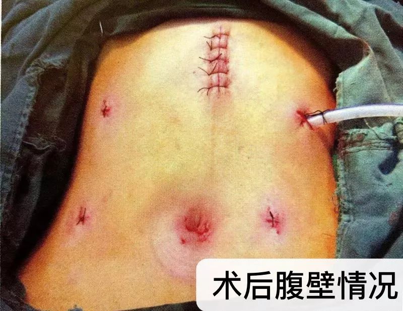  黄蜂三球接受左腕手术根治  